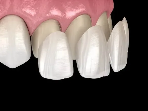 What Is Laminate Veneer?