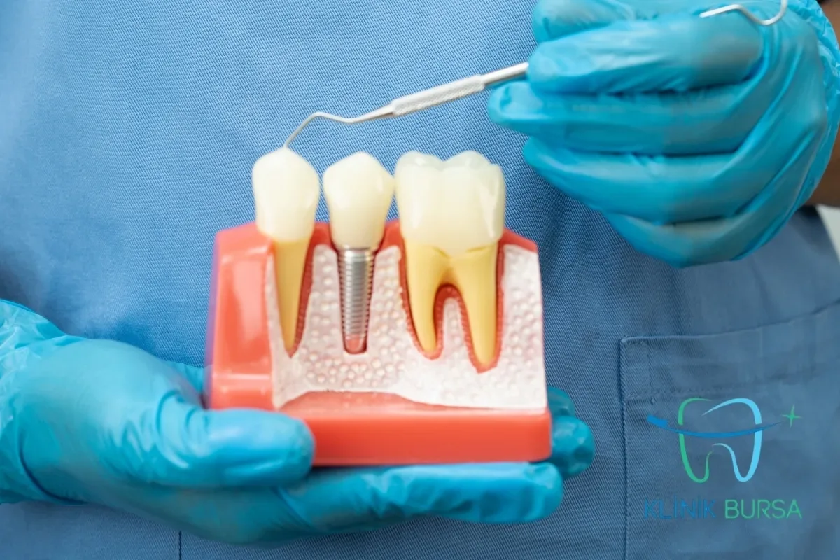 diş implantını gösteren görsel