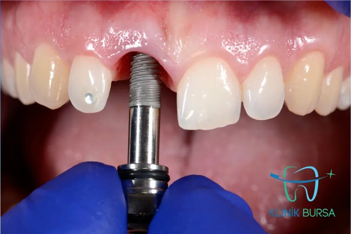 Başarısız İmplant Belirtilerini göteren implant görseli
