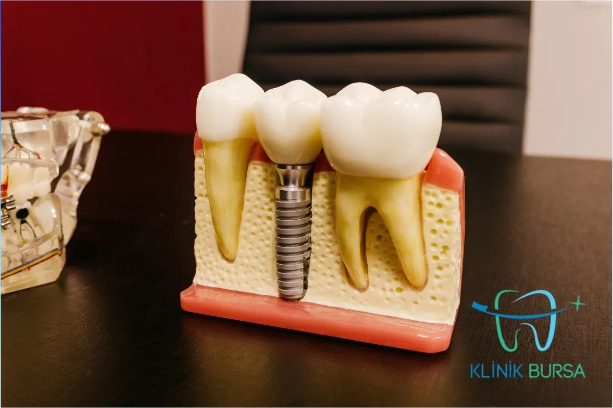 Bursa implant