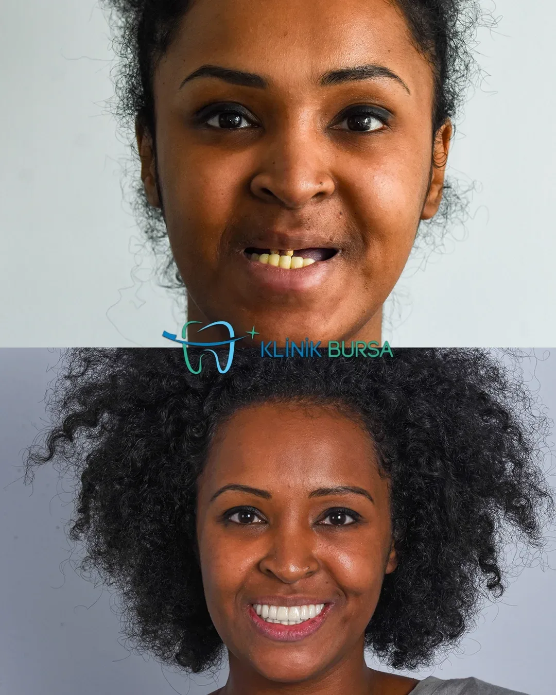 Before - After