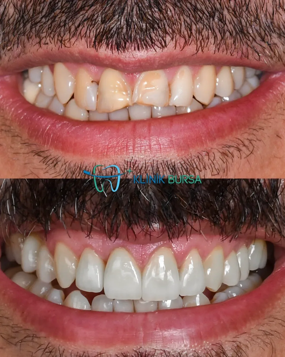 Before - After
