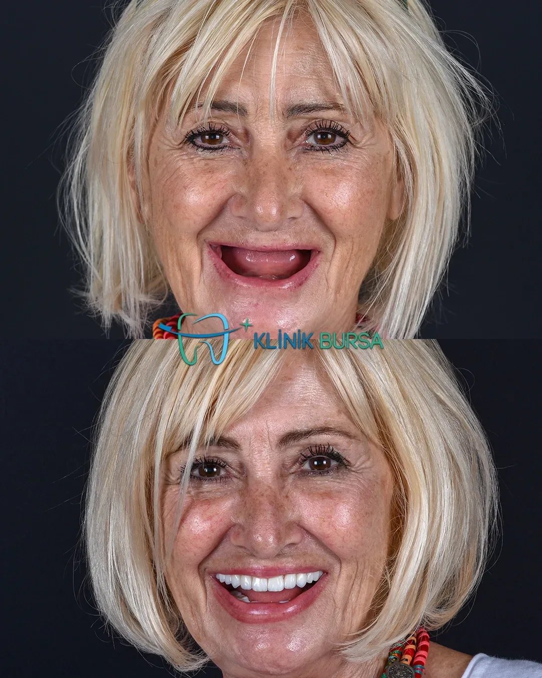 Before - After
