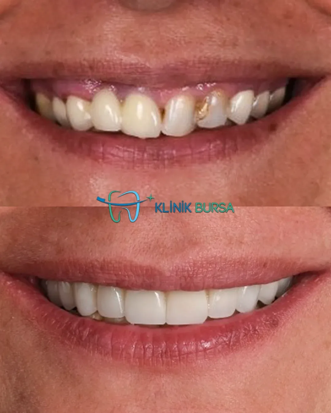 Before - After