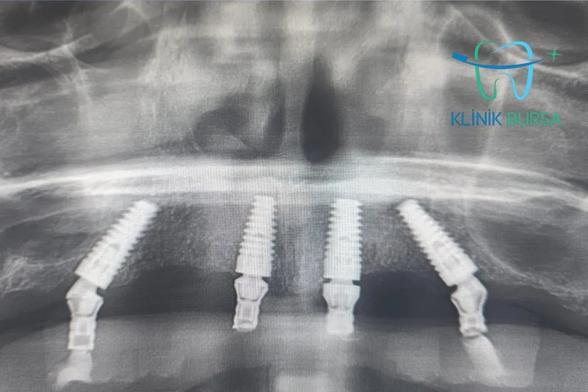 All on Four Implants modeli olan implant
