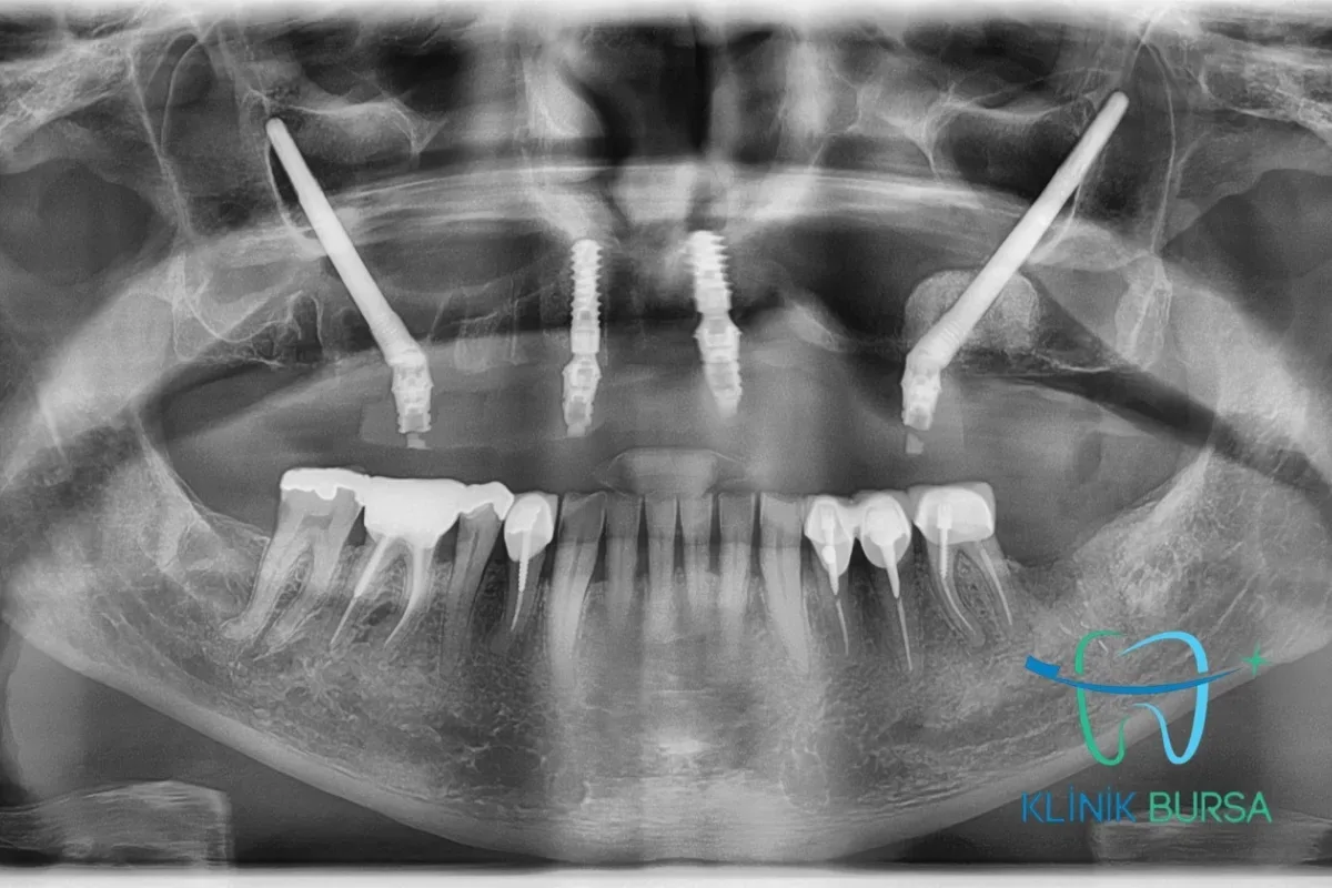 zygoma implant insan kafatasını gösteren kadın